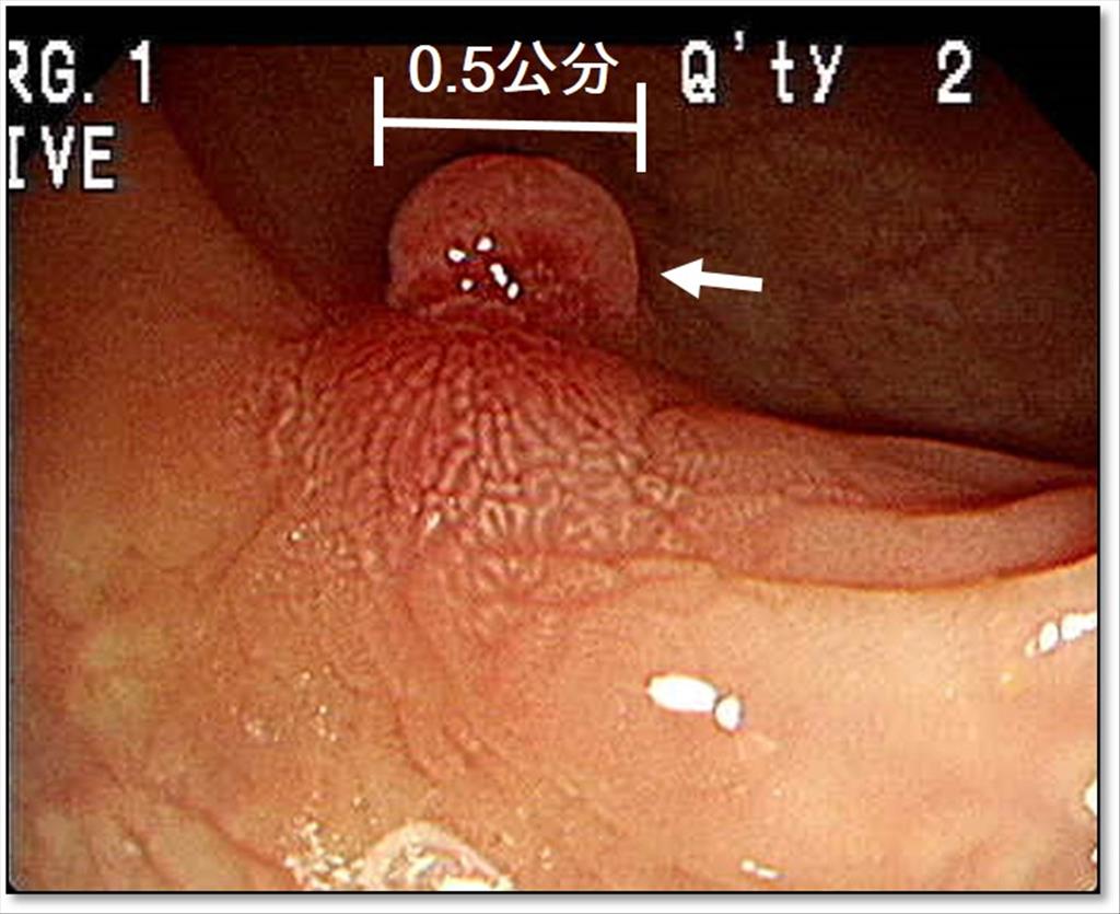 患者0.5公分大腸息肉醫療影像照