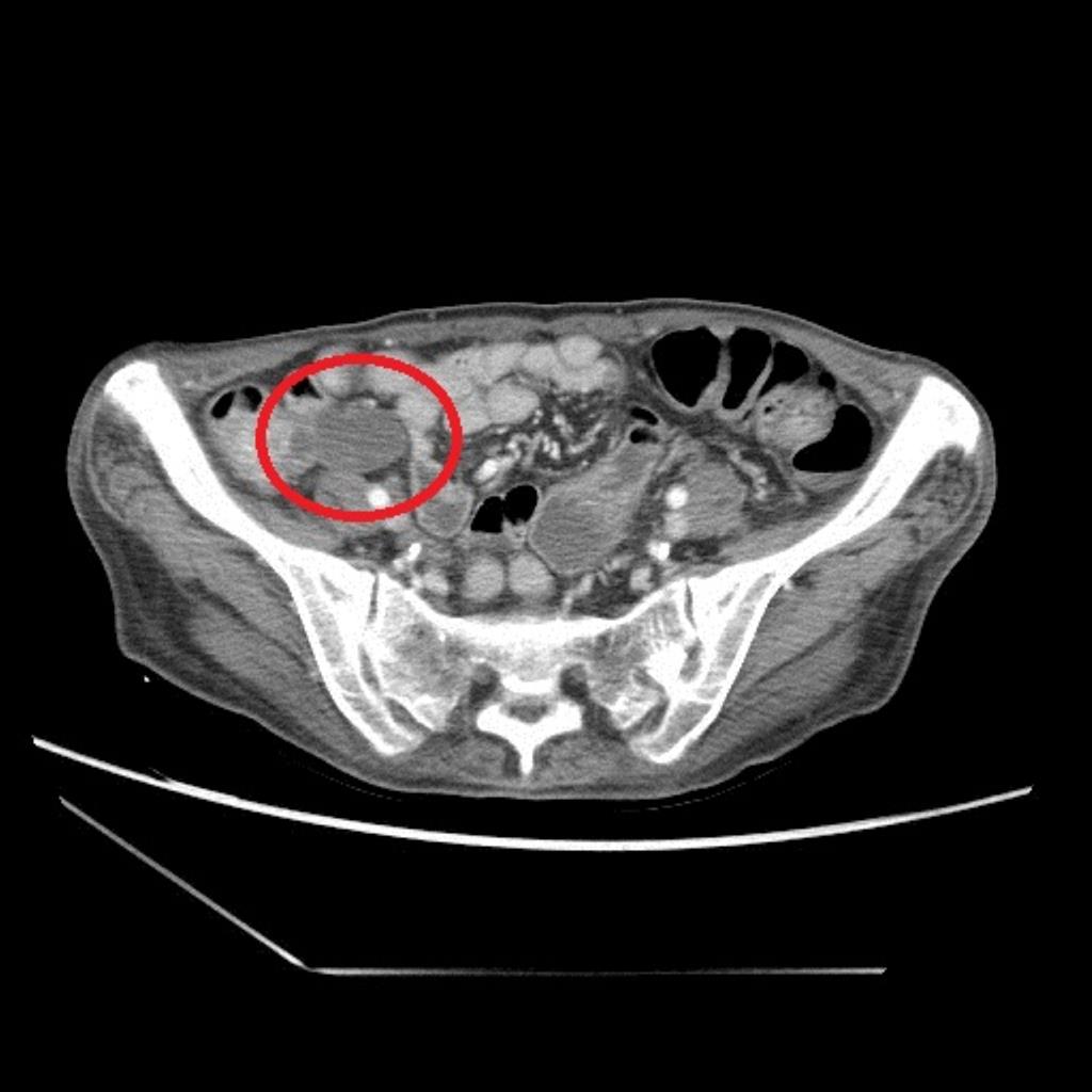 詹女士電腦斷層闌尾腫瘤位置（紅圈）